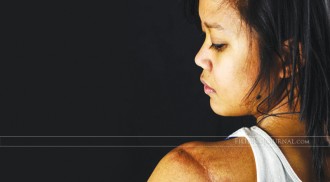 Website Gives Voice to Burn Survivors